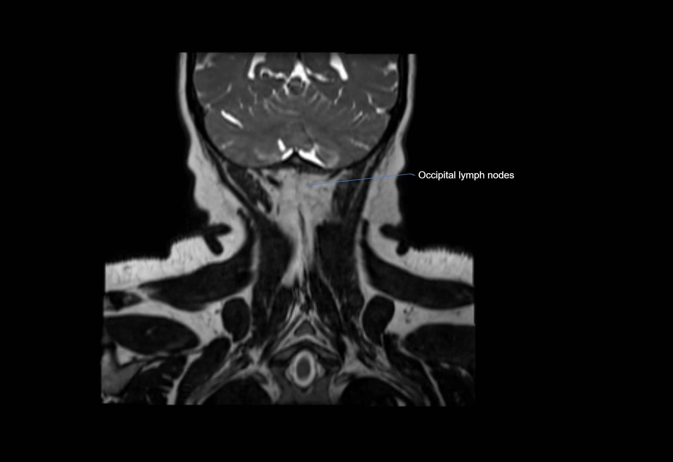 Neck coronal lymph node cross sectional MRI anatomy 3T MRI  image-img-00001-00011.webp